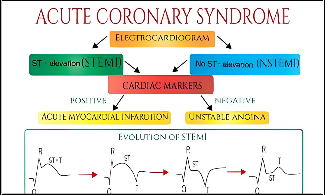 Acute Coronary Syndrome Causes, Risk Factors, Symptoms, Treatment